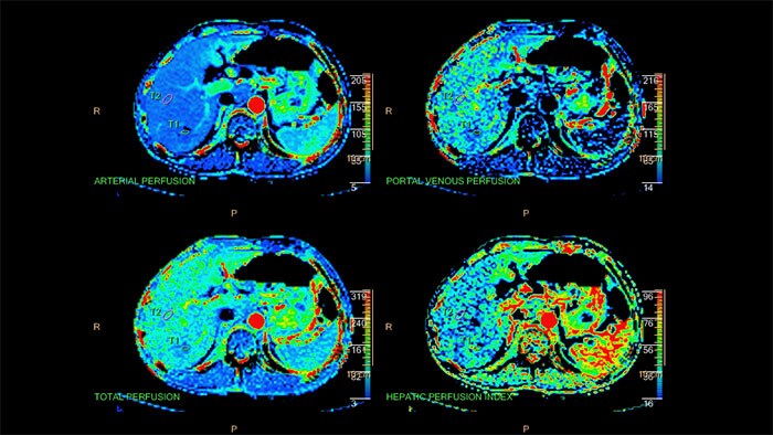 body perfusion thumbnail