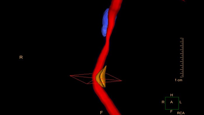 cardiac plaque assessment thumbnail