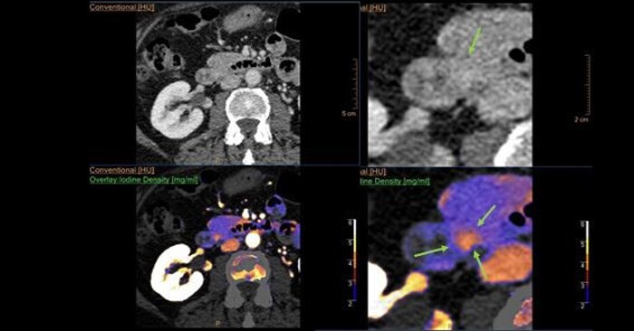 Spectral CT