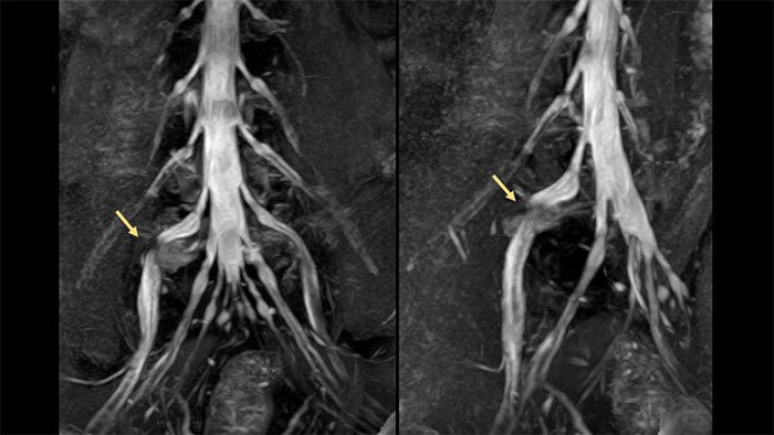 MRI nerve visualization informs surgery