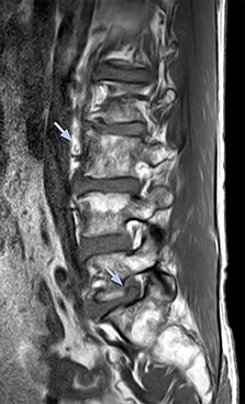 MRI of right L5 radiculopathy