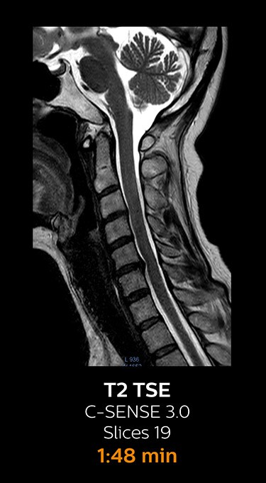 T2 TSE magnetic resonance imaging