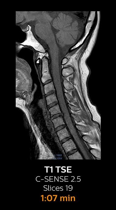 T1 TSE magnetic resonance