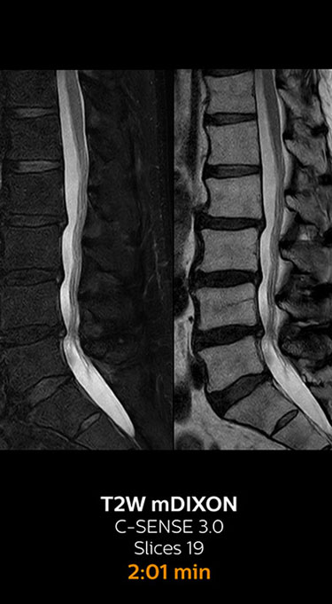 T2W mDIXON fieldstrength