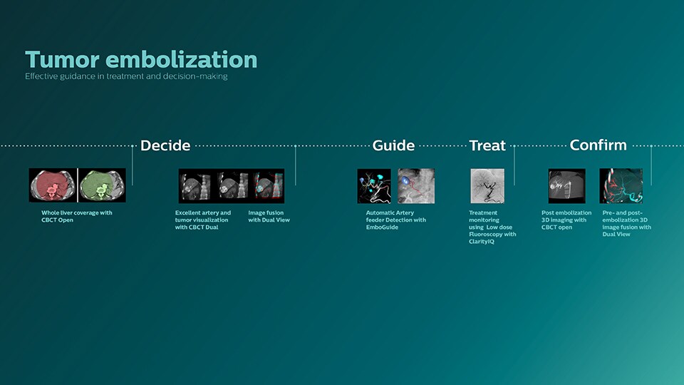 Clinical solutions for tumor embolization