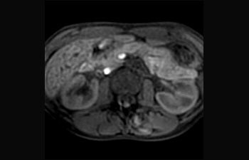 Liver and pancreas