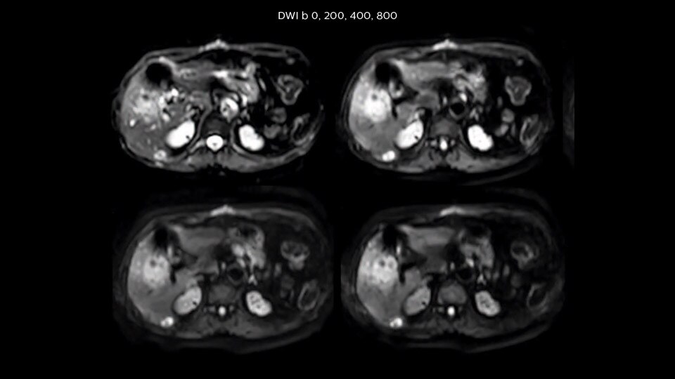 Bremen Clinical case liver MRI