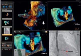 Mitral Valve New image